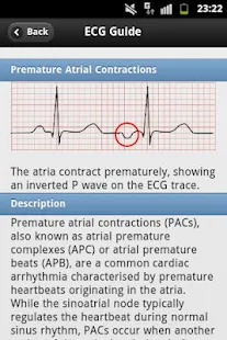 ECG Arrhythmias Pro