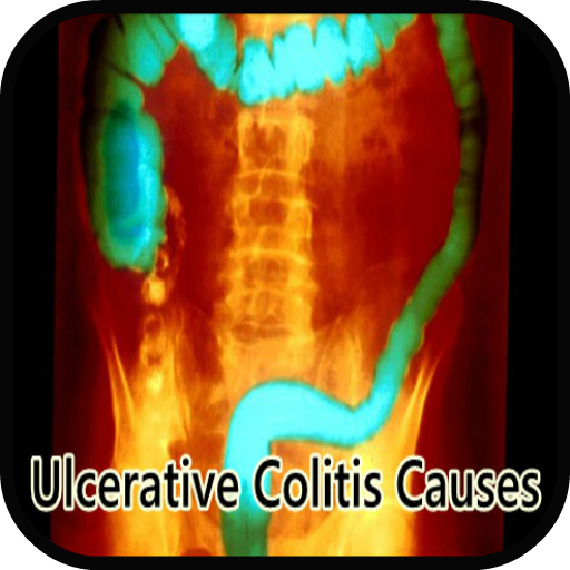 Ulcerative Colitis Causes 醫療 App LOGO-APP開箱王