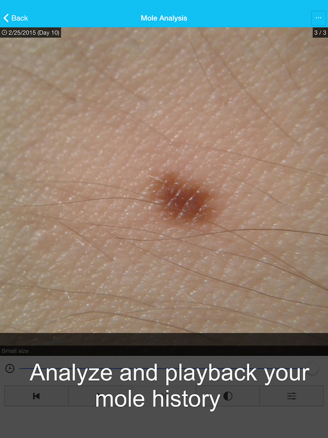    Skin Cancer App - MySkinPal- screenshot  