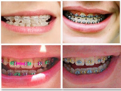 How to Make Fake Braces