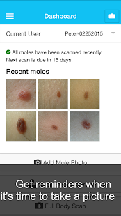   Skin Cancer App - MySkinPal- screenshot thumbnail   
