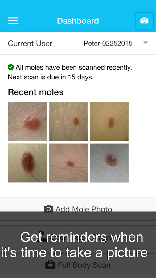    Skin Cancer App - MySkinPal- screenshot  
