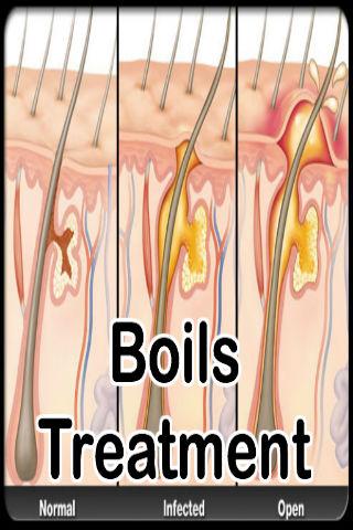 Boils Symptoms Treatment