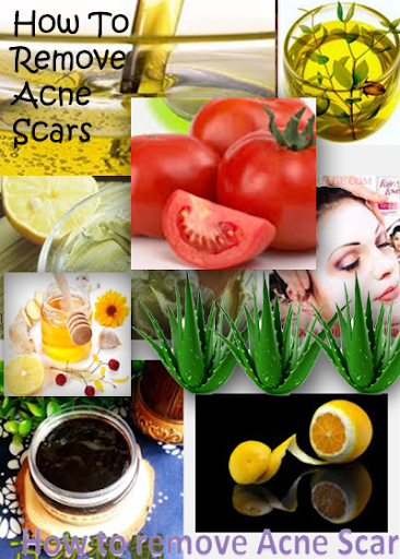 Remove Acne Scars