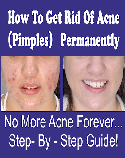 How To Get Rid Of Acne