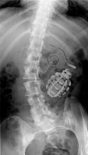 Oops-swallowed-a-grenade-small.jpg