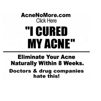 Acne Home Remedies