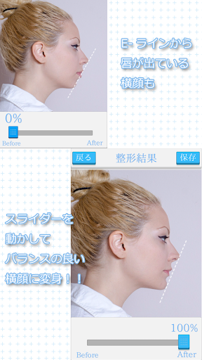 横顔E-ライン整形