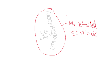 A retarded drawing of my retarded spine