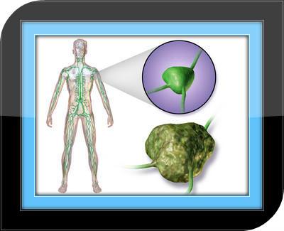 Lymphoma Symptoms - Guide