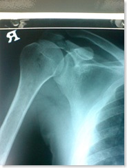 fracture on the acromion of the scapula